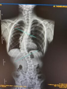 فريق طبي بـ"تداوي" دبي يصحح انحرافا حادا بالعمود الفقري لفتاة بعمر 14 عاماً