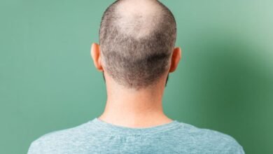 نتائج واعدة لعقار جديد لعلاج الصلع الوراثي