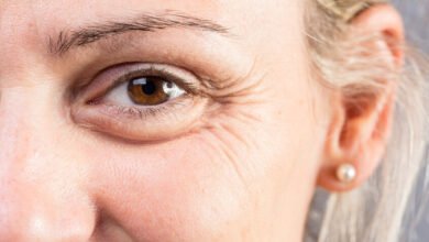 تجاعيد العينين