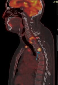 استئصال أورام معقدة من الفقرات العنقية لمريض أربعيني بمستشفى تداوي دبي 2 استئصال أورام معقدة من الفقرات العنقية لمريض أربعيني بمستشفى تداوي دبي