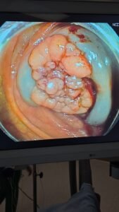 إنقاذ شاب من ورم سرطاني دون جراحة في مستشفى تداوي بدبي 2 إنقاذ شاب من ورم سرطاني دون جراحة في مستشفى تداوي بدبي