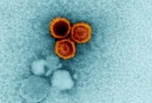 التصلب العصبي المتعدد