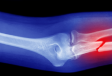 حمية غذائية تقلل من خطر كسور العظام