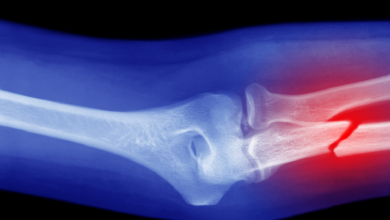 حمية غذائية تقلل من خطر كسور العظام 3 حمية غذائية تقلل من خطر كسور العظام