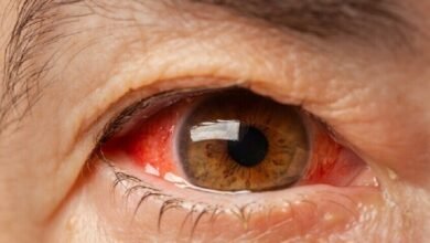 احمرار العينين صباحاً.. متى يكون طبيعياً ومتى يستدعي زيارة الطبيب؟ 42 احمرار العينين