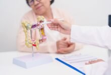 دراسة: استئصال الزائدة الدودية الملتهبة قد يقلل خطر الإصابة بسرطان القولون 42 سرطان القولون